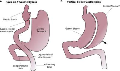 Bariatric Surgery: Targeting pancreatic β cells to treat type II diabetes